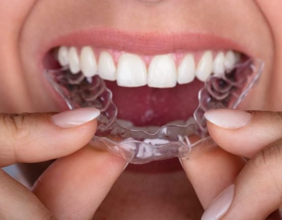 Aligners